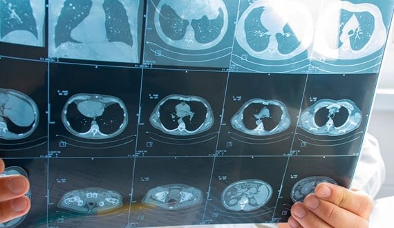 cause of mesothelioma